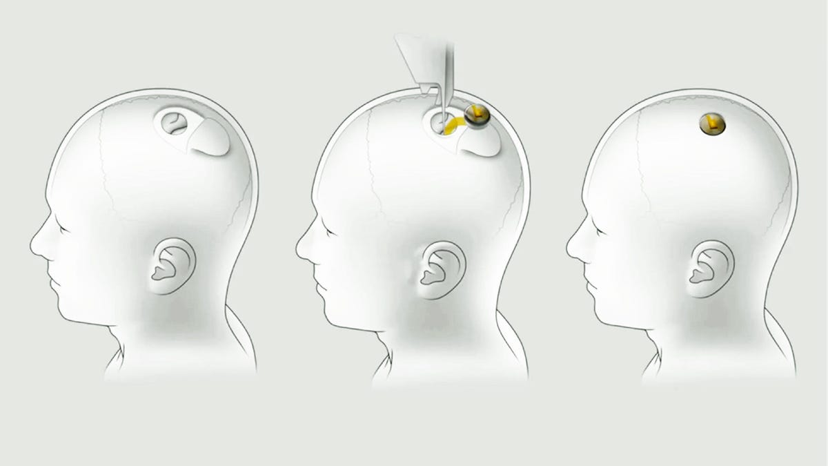 Elon Musk Neuralink Update
